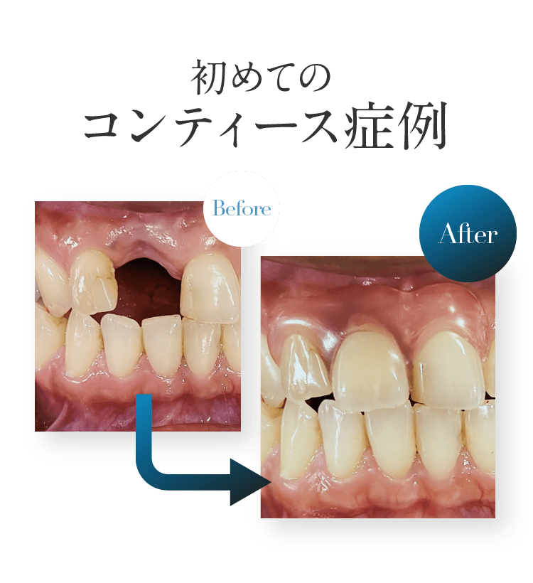 初めてのコンティース症例